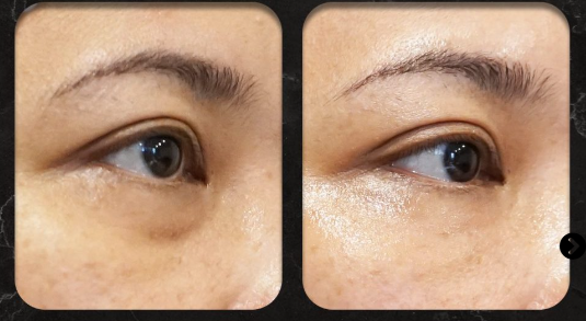 Cara Kerja Filler Kantung Mata dalam Mengencangkan Area Wajah Bawah